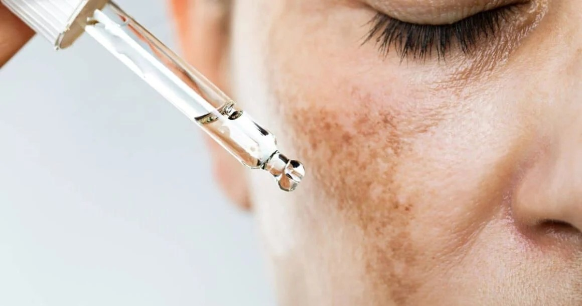 Discover The Best Chemical Peel For Hyperpigmentation