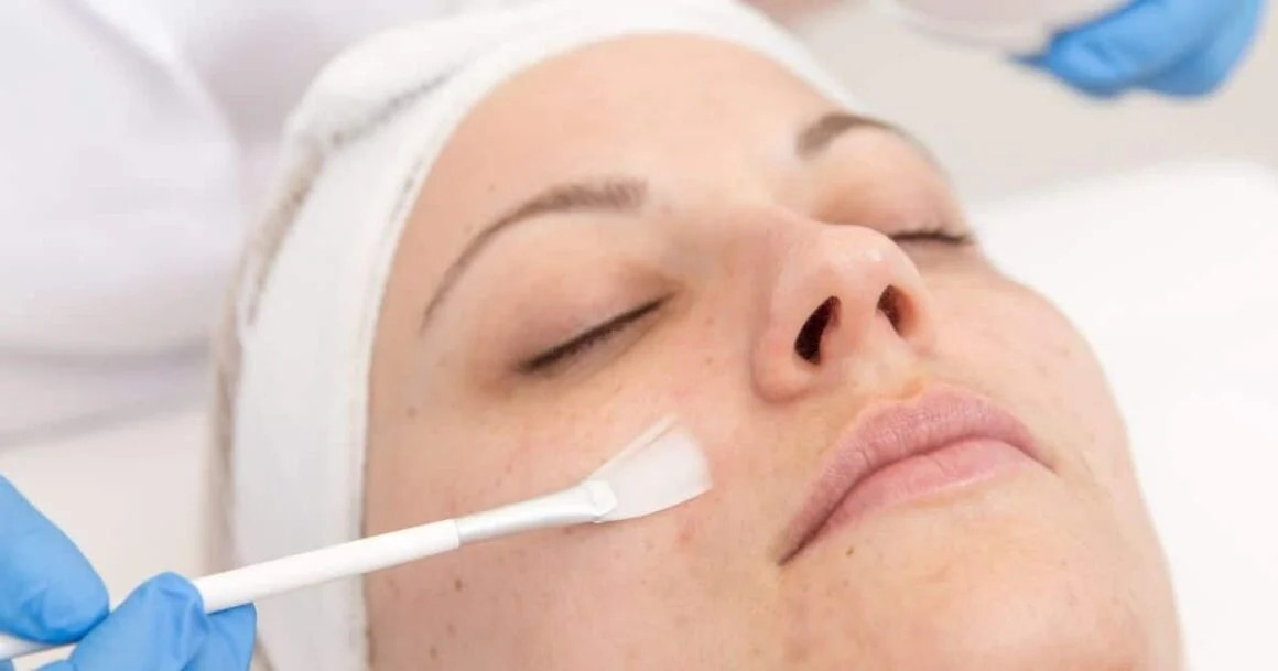 Exciting Chemical Peel Benefits For Radiant Skin